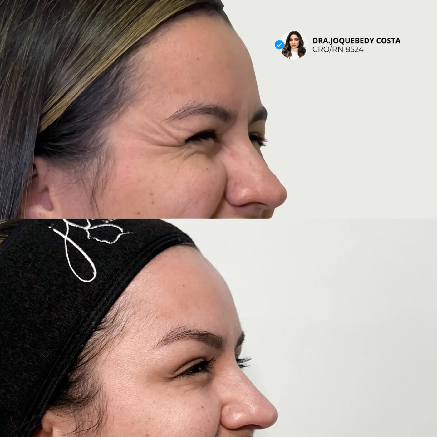 Antes e depois de toxina botulínica na área dos olhos realizada pela Dra. Joquebedy Costa