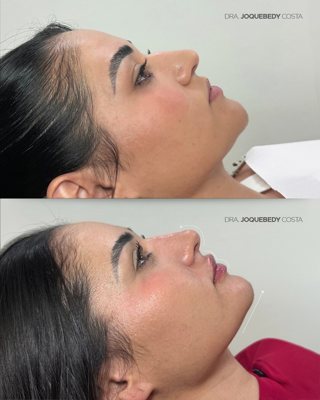 Antes e depois de harmonização orofacial realizada pela Dra. Joquebedy Costa