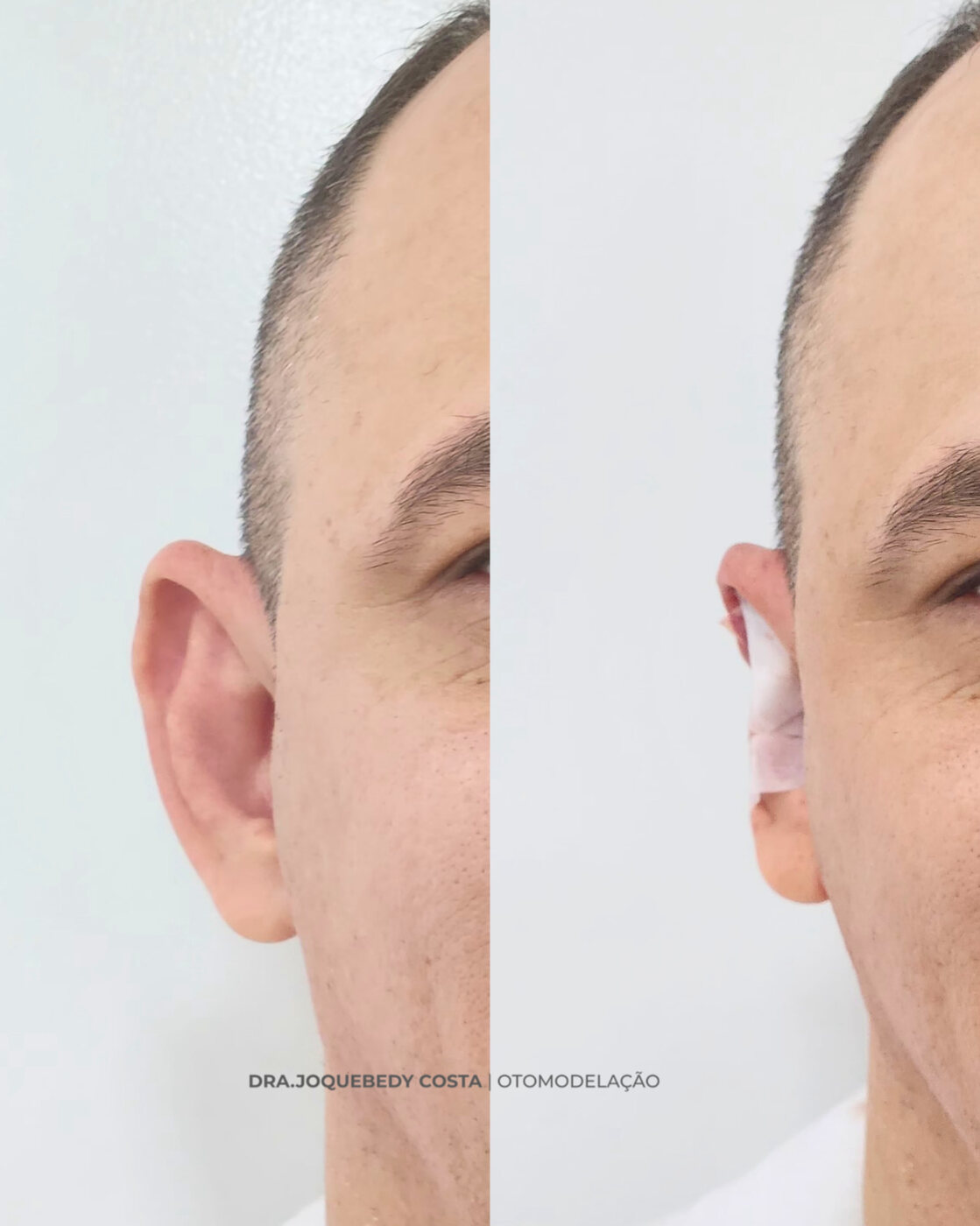 Antes e depois de otomodulação realizada pela Dra. Joquebedy Costa