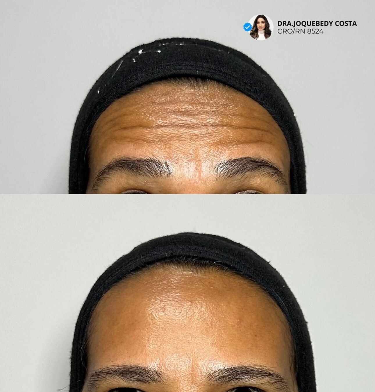 Antes e depois de toxina botulínica na testa realizada pela Dra. Joquebedy Costa